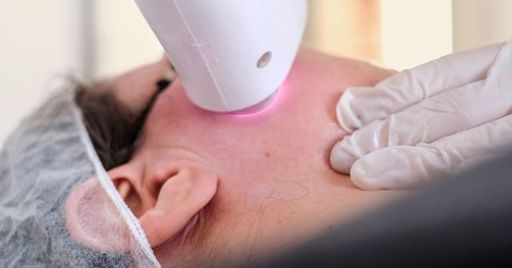 laser-face-melasma-1200x628-facebook (1).jpg