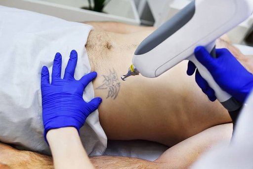 Determine-Laser-Tattoo-Removal-Success (1).jpg