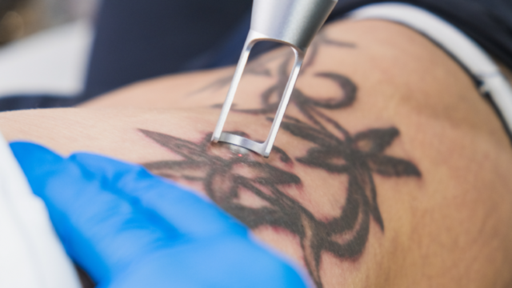 Tattoo-Removal-CU_1600x900.png