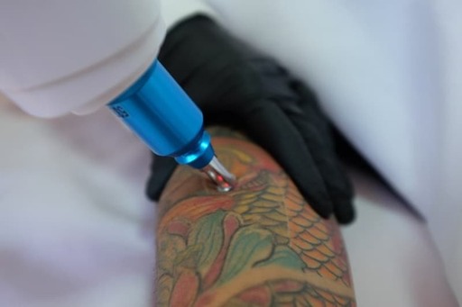 Laser-Tattoo-Removal-FAQs.jpg