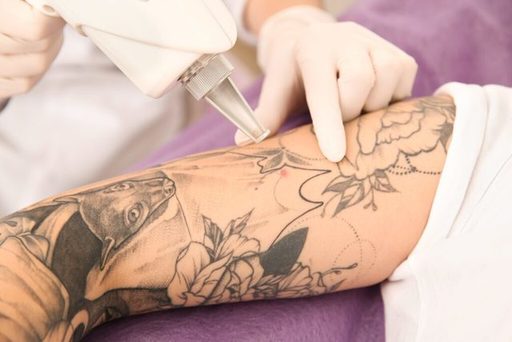 insert-a-zoomed-in-photo-of-a-tattoo-being-laser-r