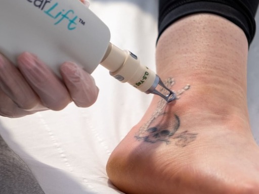 Tattoo-removal (3).jpg