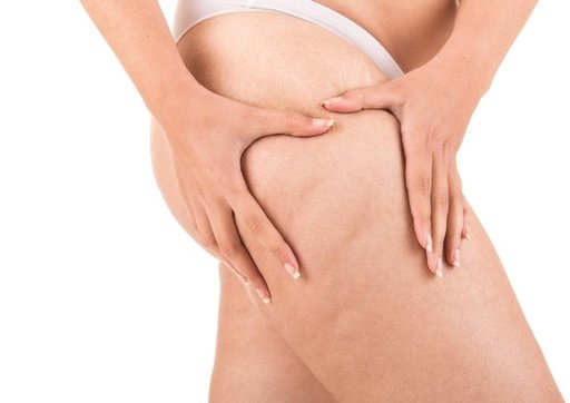 Woman+showing+her+cellulite.jpg